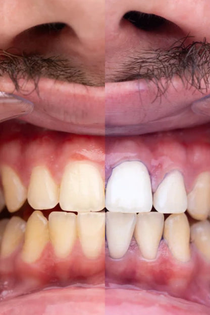 Blanqueador Dental Lila V34 + BLANQUEADOR DENTAL UV – KIT CON LUZ LED